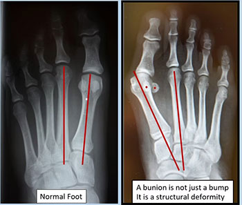 bunion