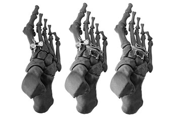psi patient specific instruments